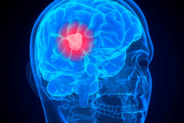 Neurinoma acustico