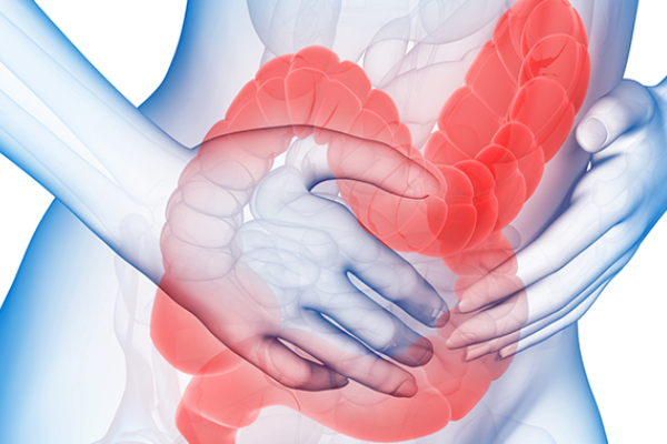 La sindrome dell’intestino irritabile
