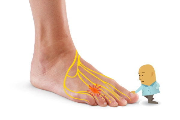 Neuroma di Morton