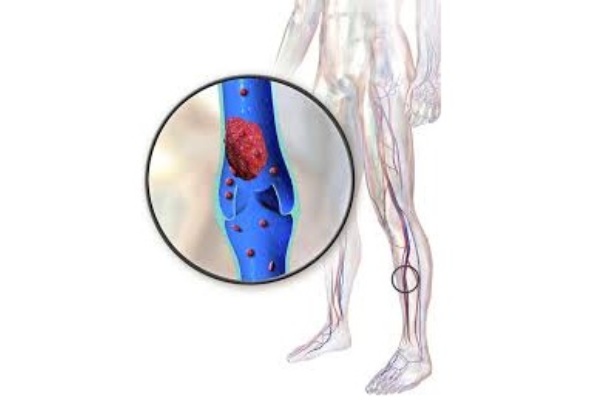 Tromboflebite sintomi e complicazioni