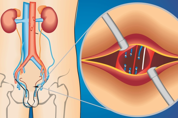 Varicocele ed infertilità maschile