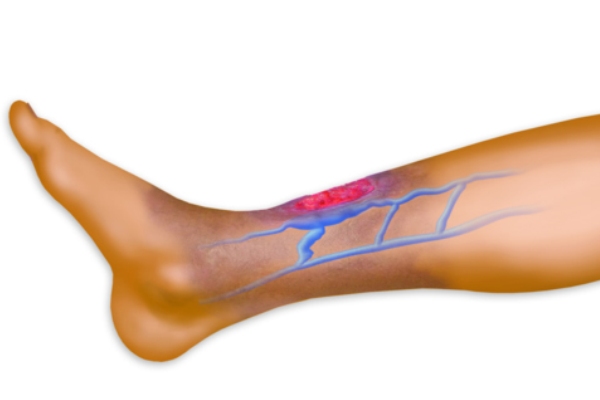 Tromboflebite superficiale