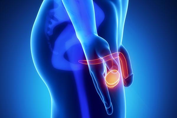 Varicocele cause e conseguenze